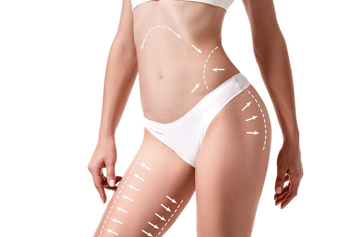 Liposuccion dans Carpentras