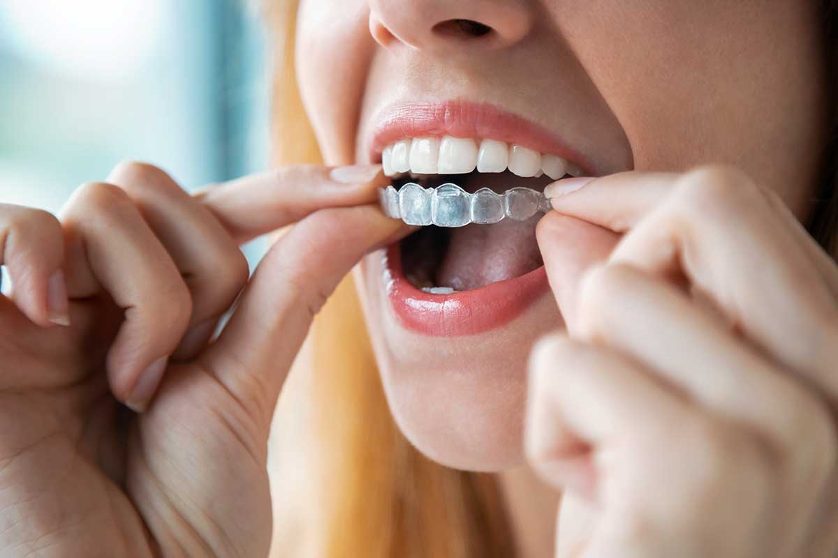 Traitement Invisalign